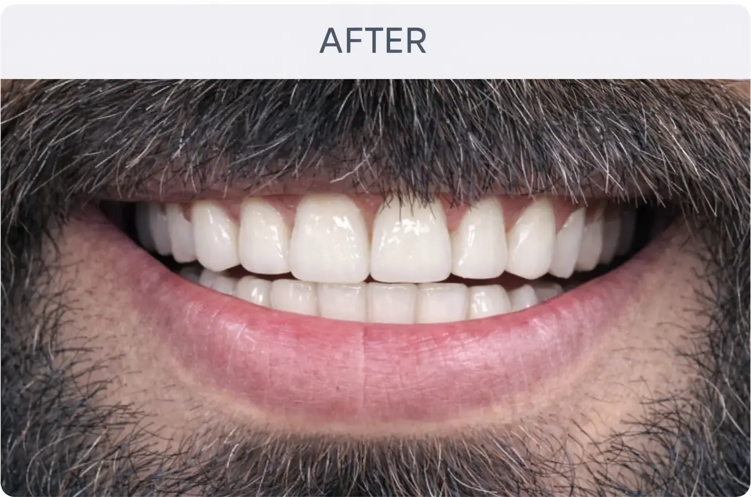 Cosmetic Dentistry After Treatment in Ahmedabad
