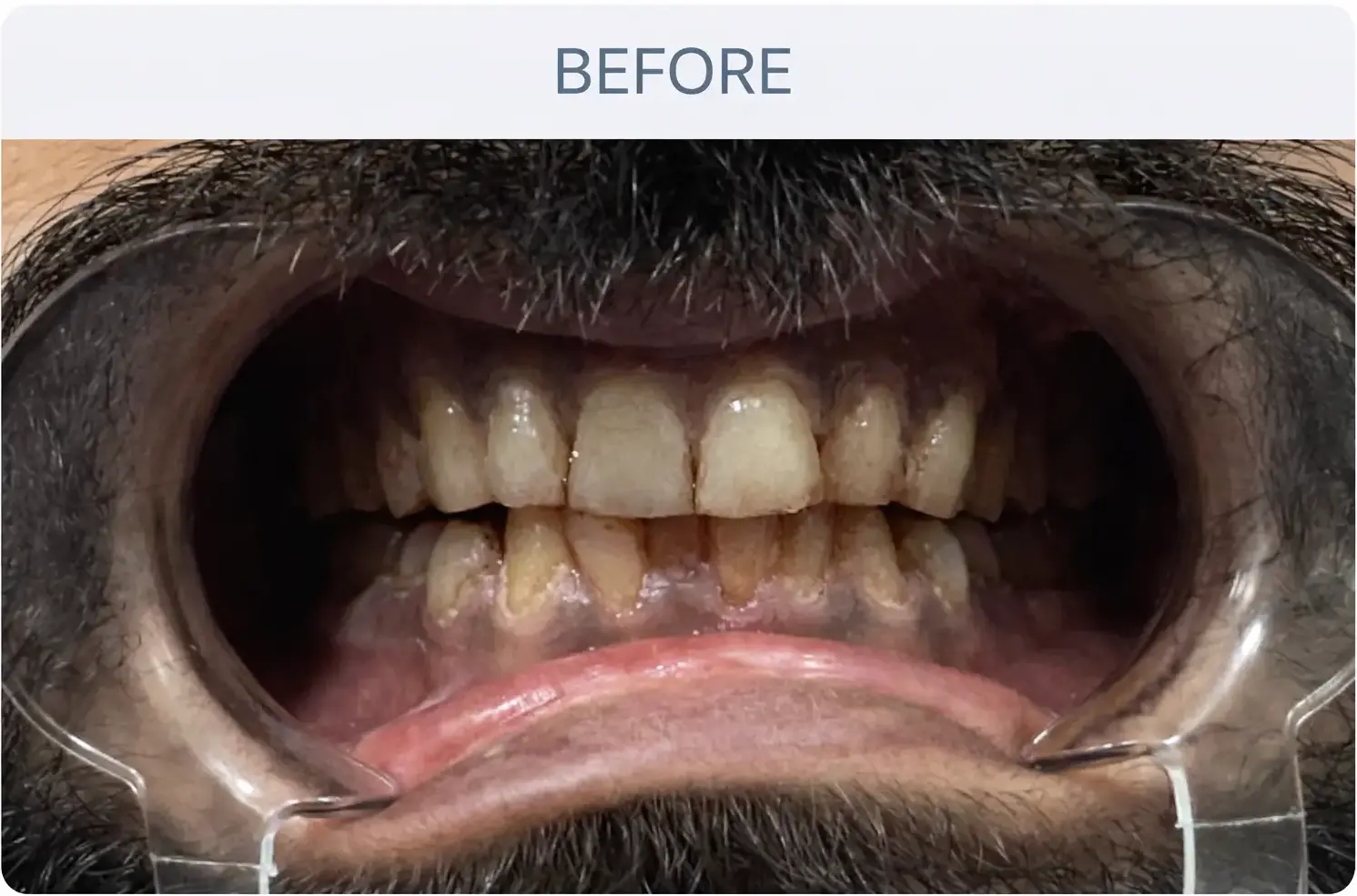 Cosmetic Dentistry Before Treatment in Ahmedabad