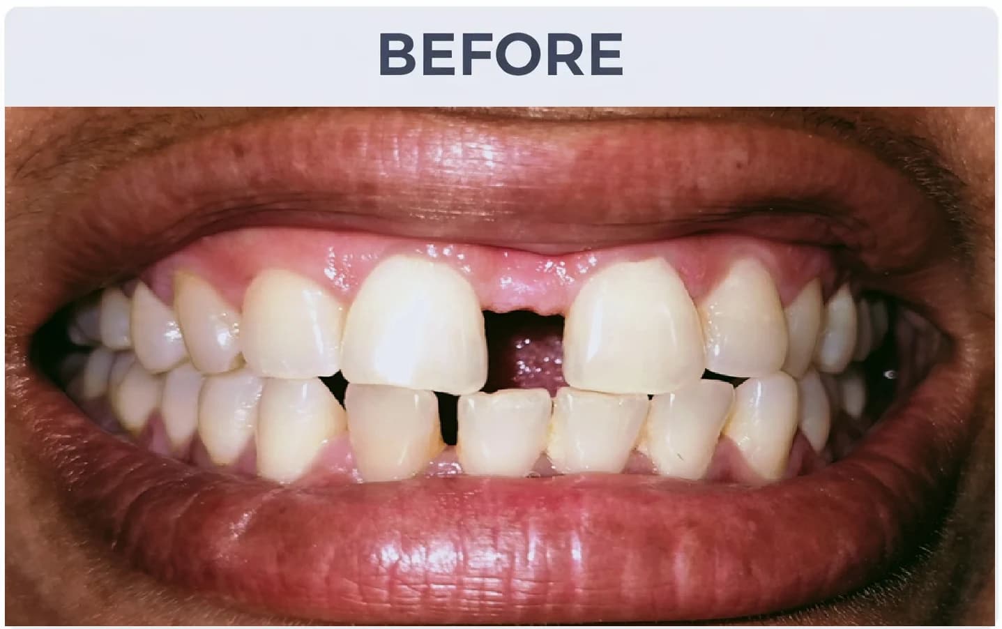 Complex Smile Makeover Before
